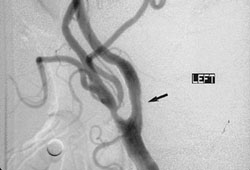 [Euro-Stroke2009]国际颈动脉支架研究（ICSS）的安全性结果：随机接受颈动脉支架成形术和颈动脉内膜切除术治疗的症状性颈动脉狭窄患者的早期转归  