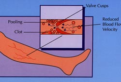 [Euro-Stroke2009]CLOTS试验：下肢逐级加压弹力袜对于急性卒中患者近端深静脉血栓形成风险的影响  